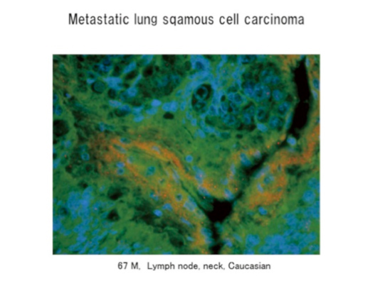 Metastic lung sqamous cell carcinoma